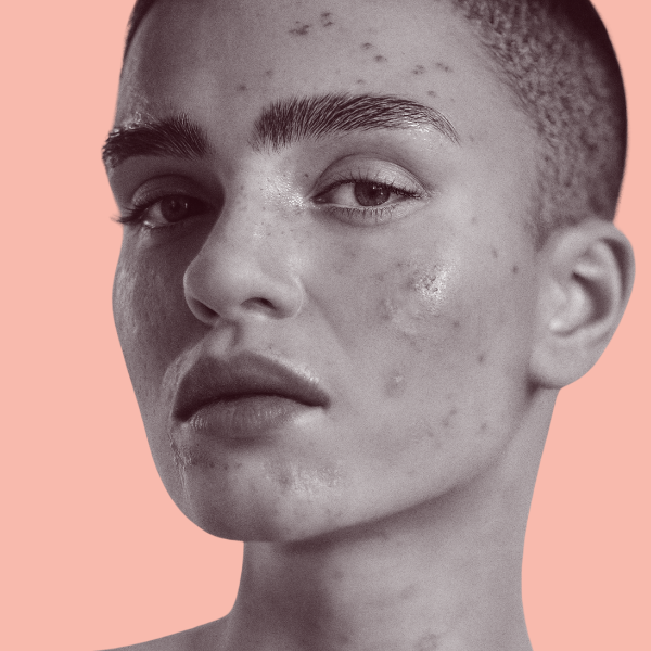 Hormonal Acne: Managing Your Skin's Cyclical Battle